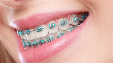 types of metal braces brackets|traditional metal braces for adults.